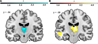 Coping With Anxiety: Brain Structural Correlates of Vigilance and Cognitive Avoidance